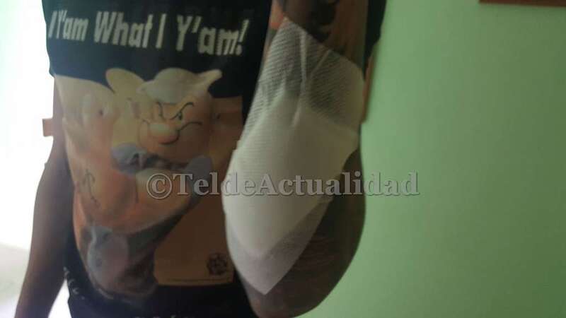 Brazo del  joven que resultó herido en la reyerta callejera del pasado lunes por la noche en Jinámar (Foto TA)